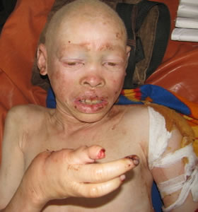 Notorios e horripilantes Crimes de 2013 - Caça aos Albinos na Tanzania