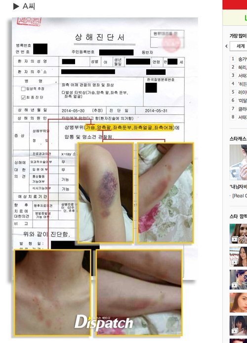 Na foto: Imagens dos hematomas divulgados numa rede social coreana pela namorada de Kim Joon. Créditos: Dispatch.