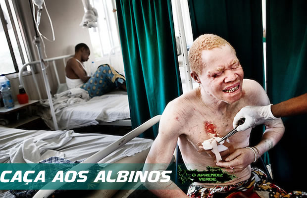 101 Crimes Horripilantes de 2014 - Caça aos Albinos